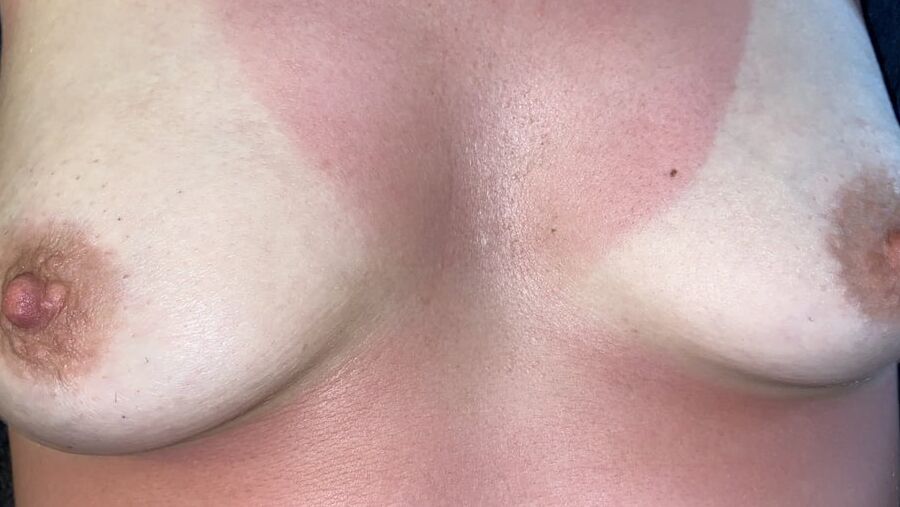 WHORE SUNBURNT!!
