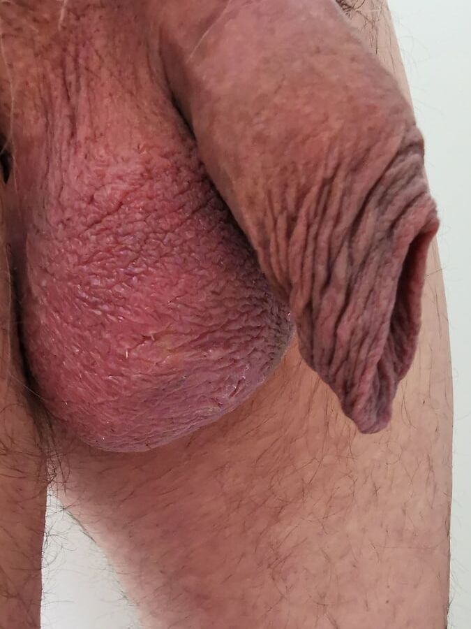 My loose foreskin