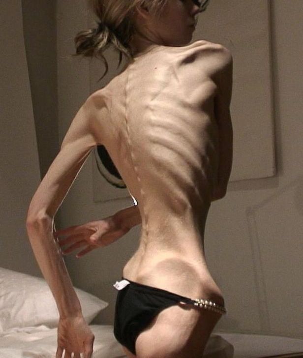 Anorexic-Cunts