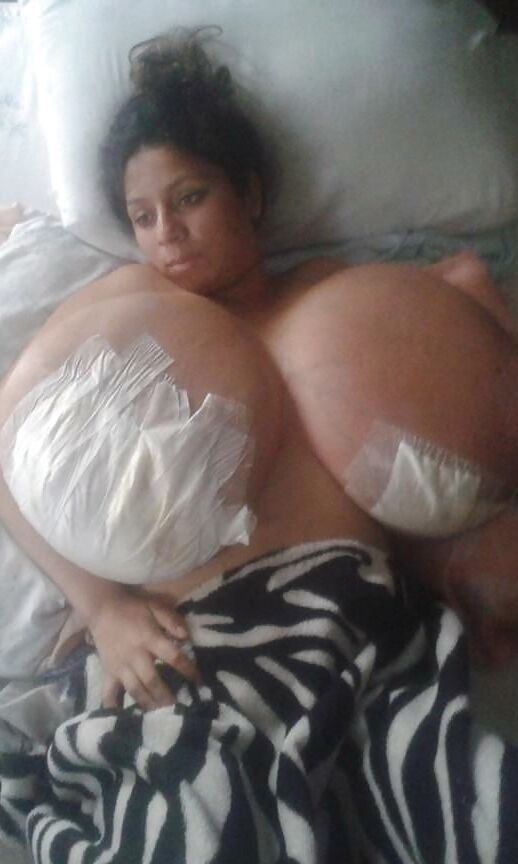 Massive Tits Breast Reduction