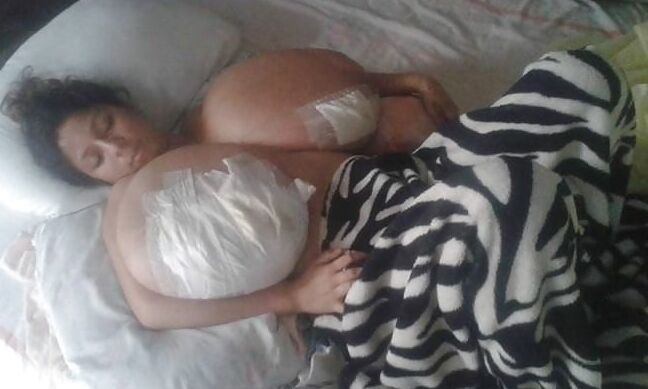 Massive Tits Breast Reduction