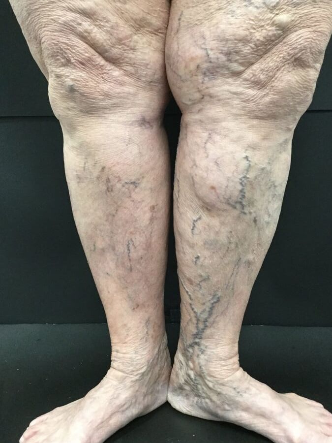 varicose veins &amp; spider veins