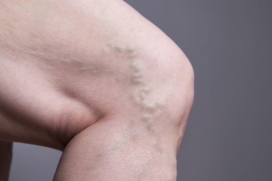 varicose veins &amp; spider veins