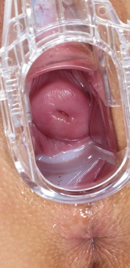 SPECULUM OPEN WIDE BEAUTIES CERVIX VIEW - CoViD-
