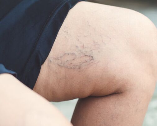varicose veins &amp; spider veins