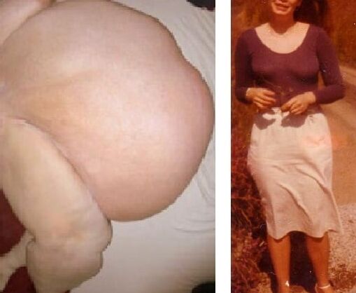 Weight Gain Before And After