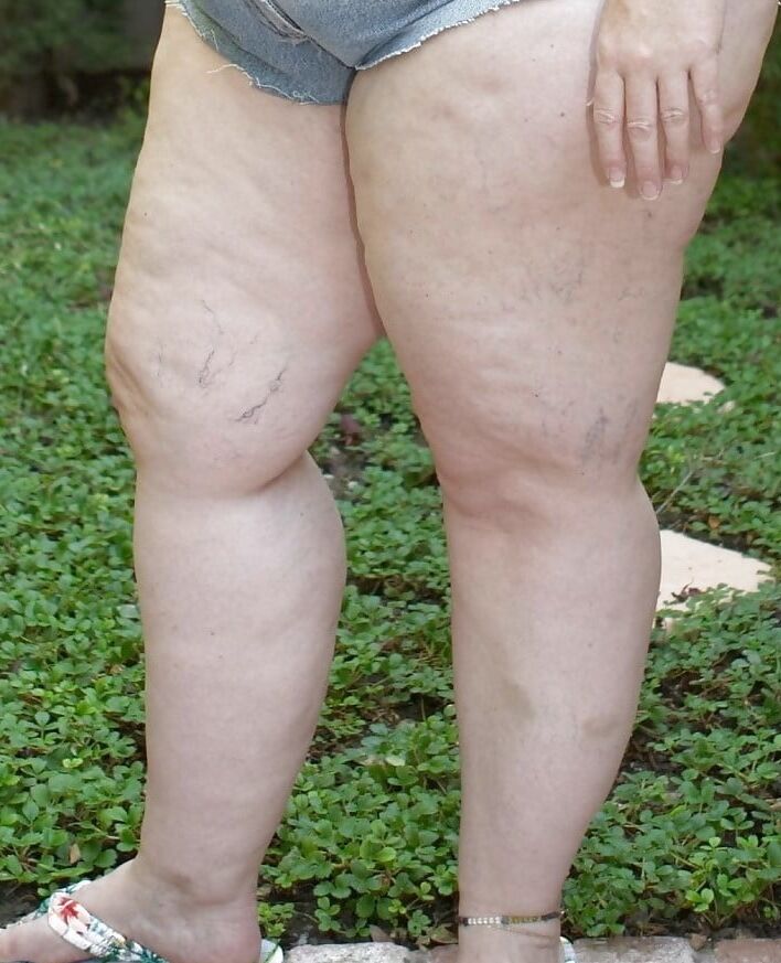 Sexy Cellulite and Stretchmarks