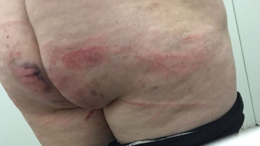 Marks and Bruises
