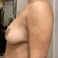 Saggy breast vol