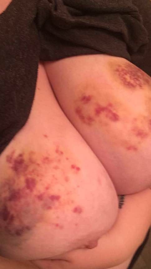 Marks and Bruises