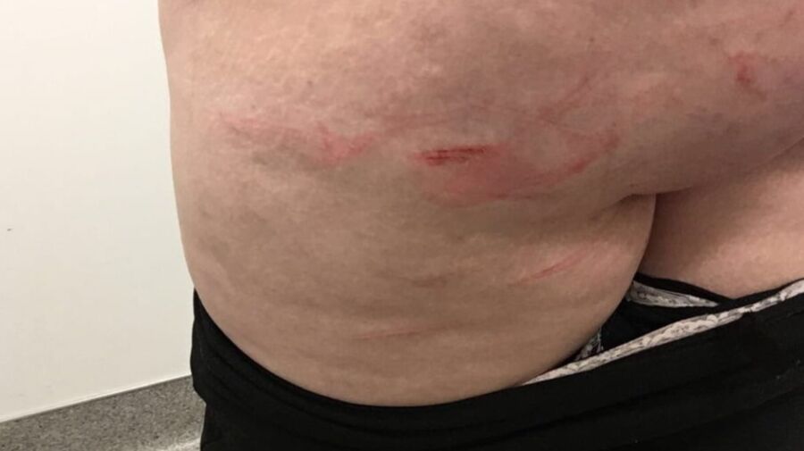 Marks and Bruises