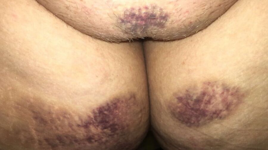 Marks and Bruises