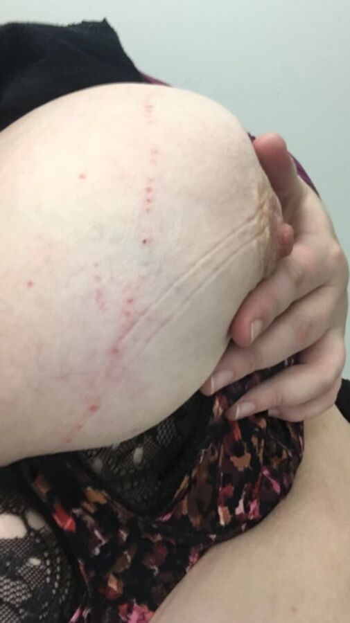 Marks and Bruises