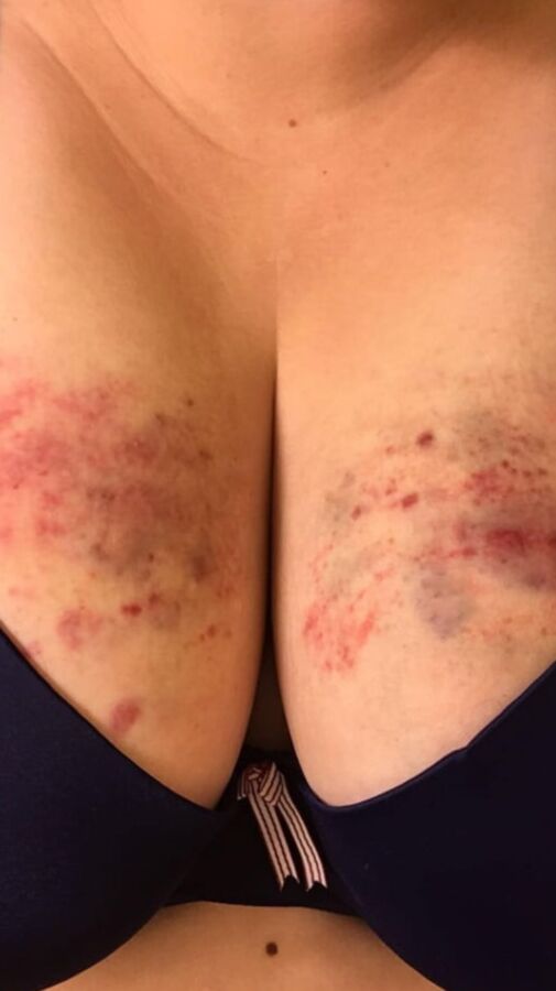 Marks and Bruises
