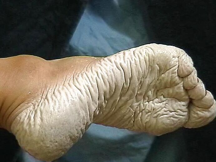 wrinkles