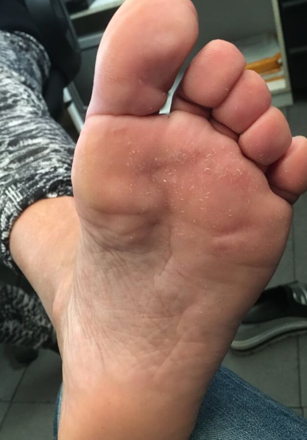 Piante dei piedi mature