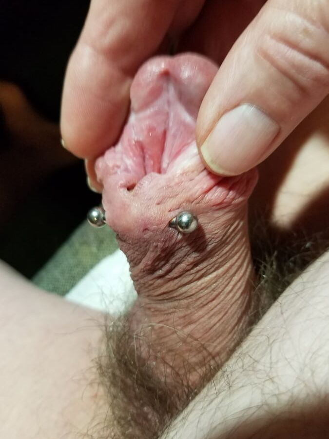 Subincision enlargement