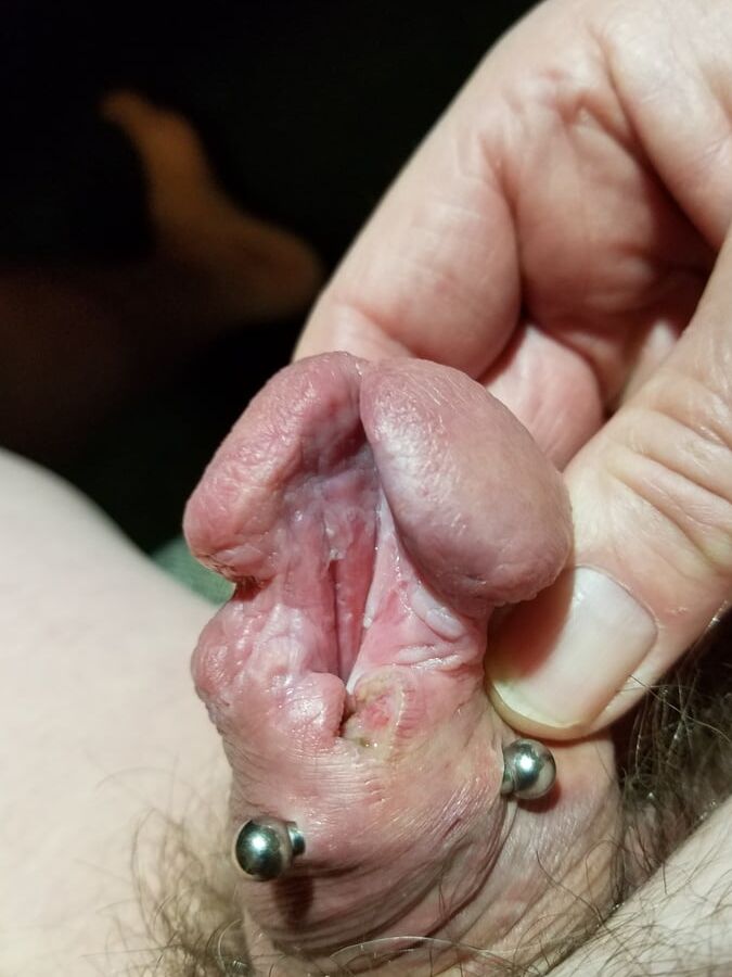 Subincision enlargement