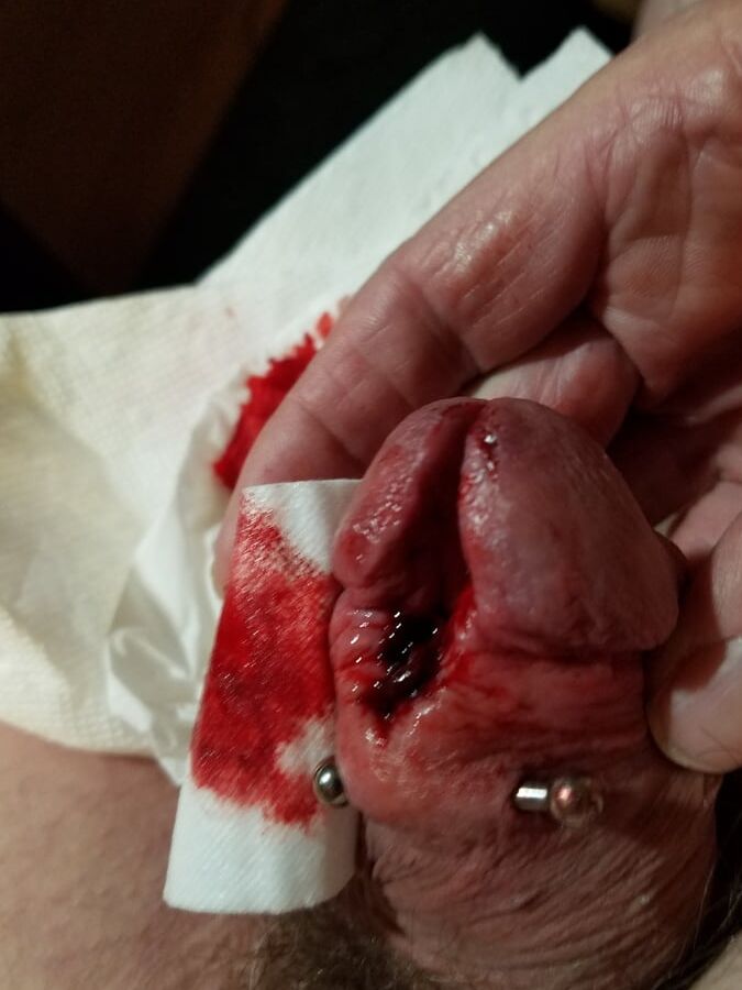 Subincision enlargement