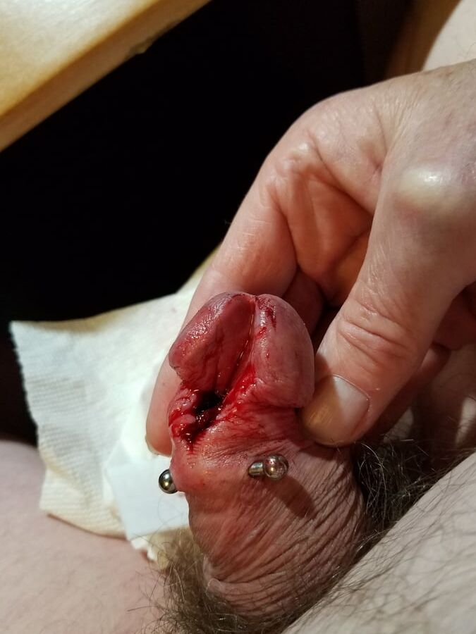 Subincision enlargement
