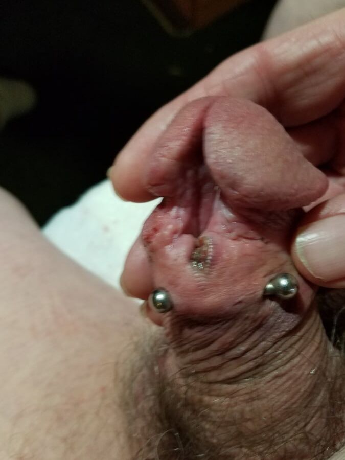 Subincision enlargement