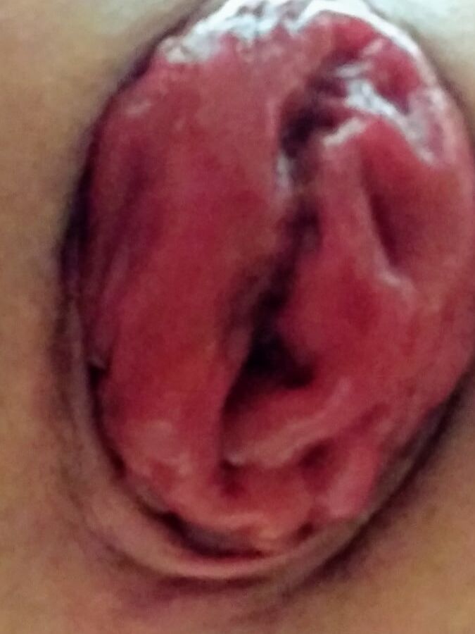 Prolapse