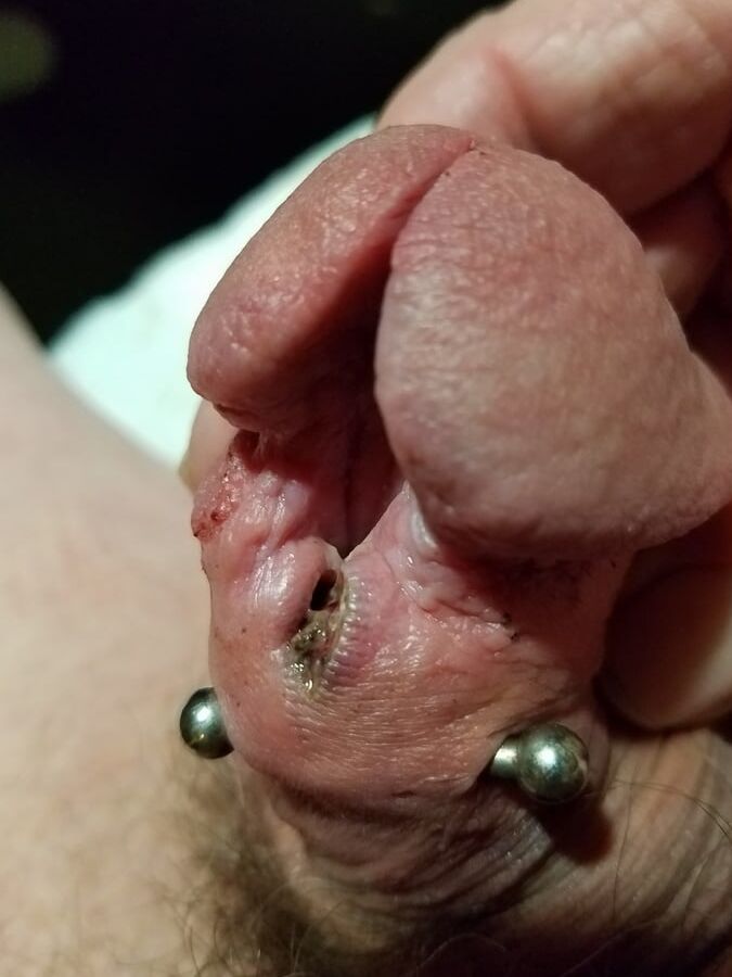 Subincision enlargement