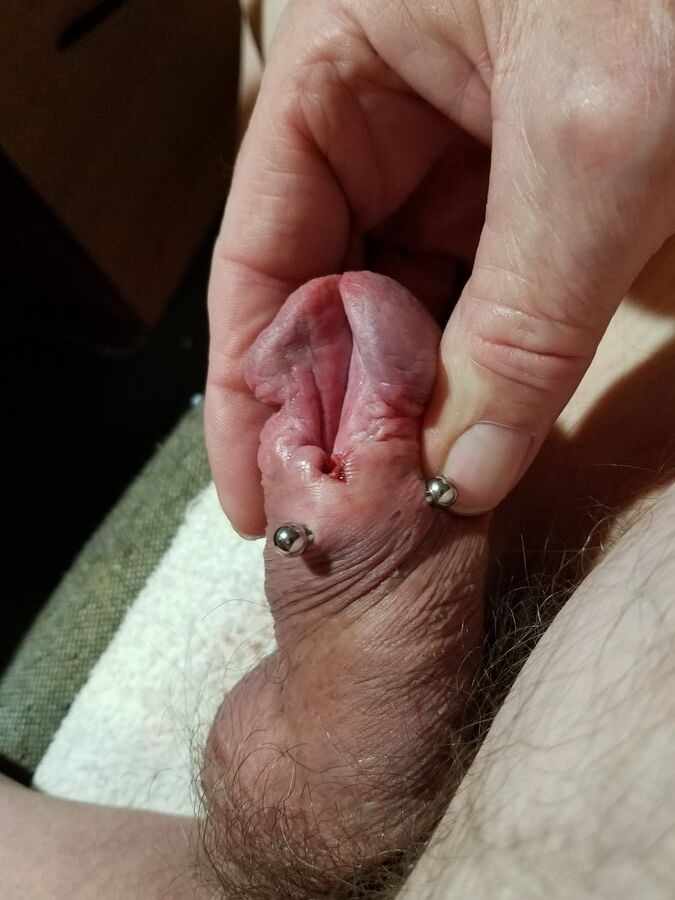 Subincision enlargement