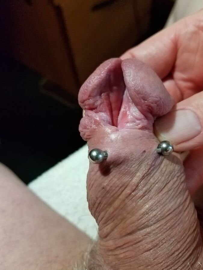 Subincision enlargement