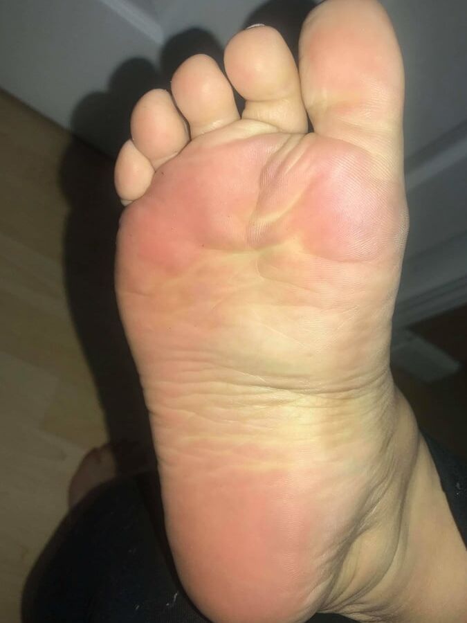 year old BBW mexican Soles Nut draining wrinkles