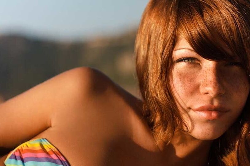 Freckles