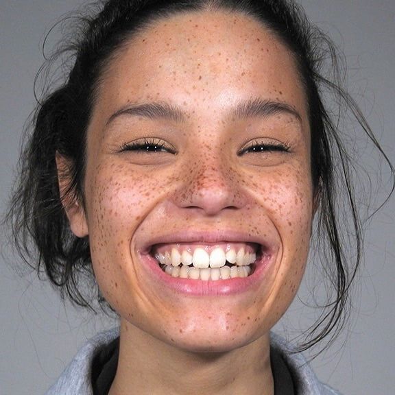 Freckles