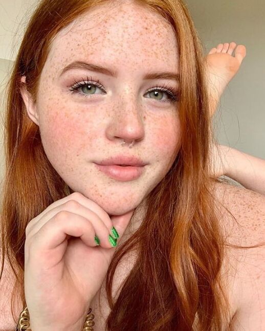 Freckles