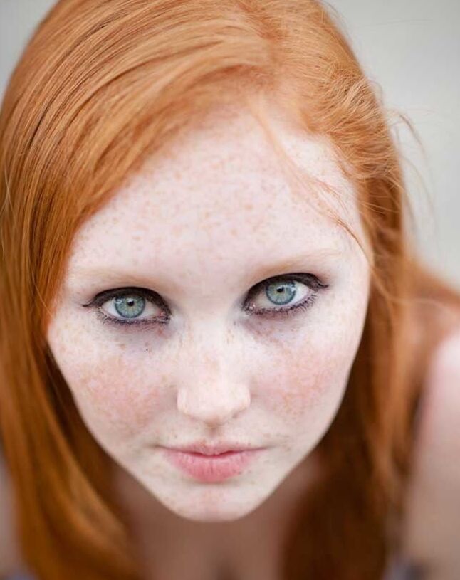Freckles