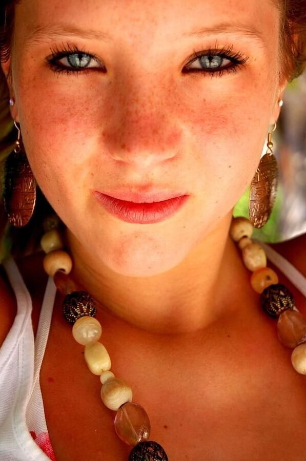 Freckles