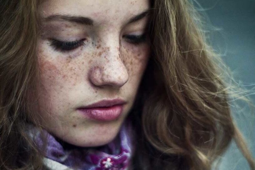 Freckles