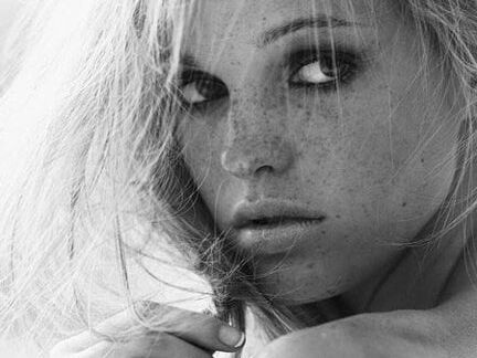 Freckles