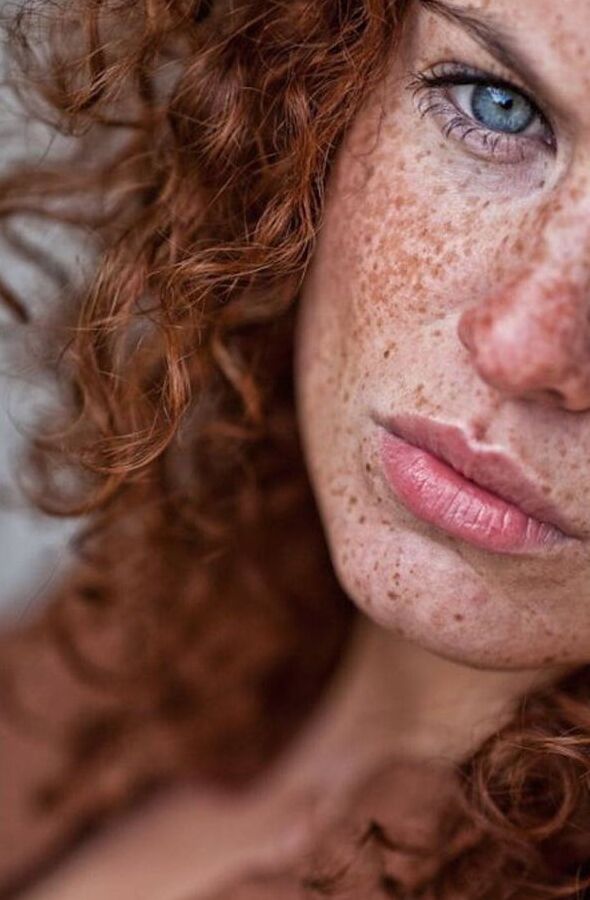 Freckles
