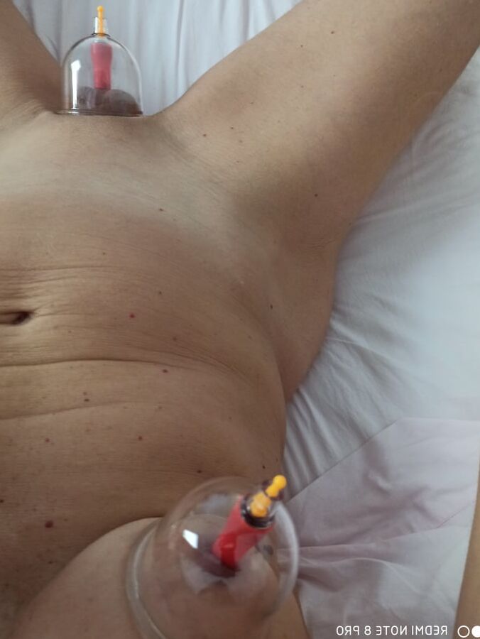 Cupping
