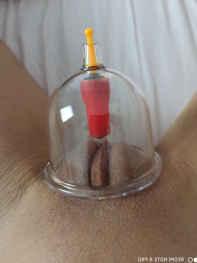 Cupping