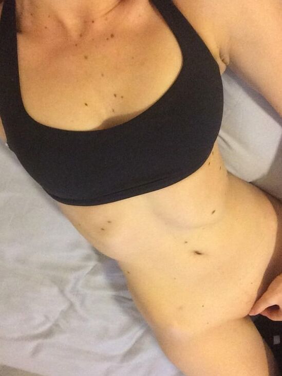 Birthmarks