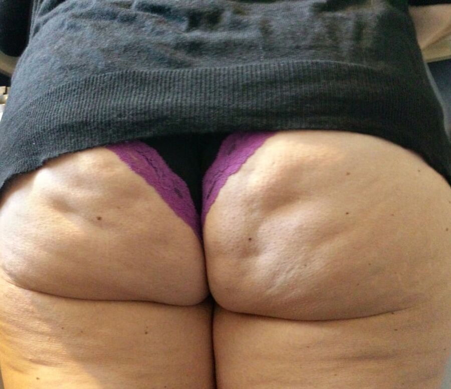 Cellulite Dimples