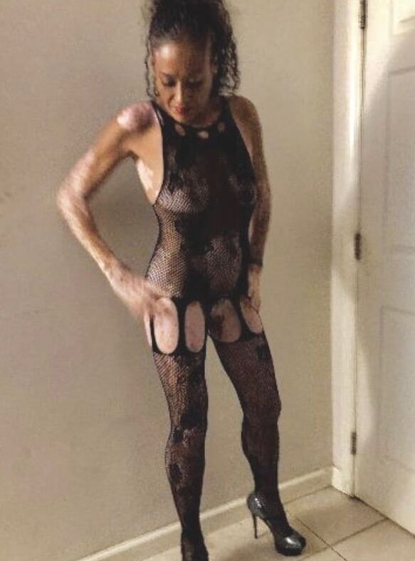 Local Whore - With Vitiligo