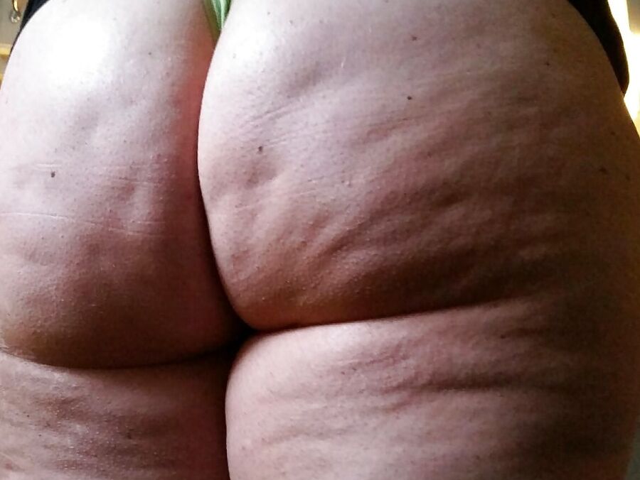 Cellulite Dimples