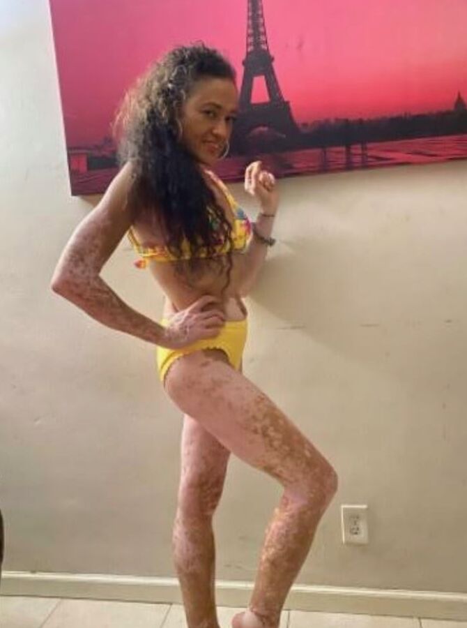 Local Whore - With Vitiligo