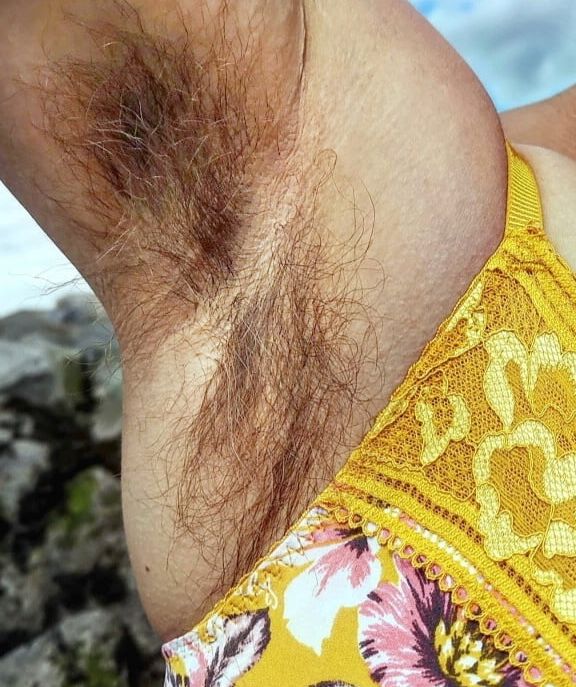 Hirsutism