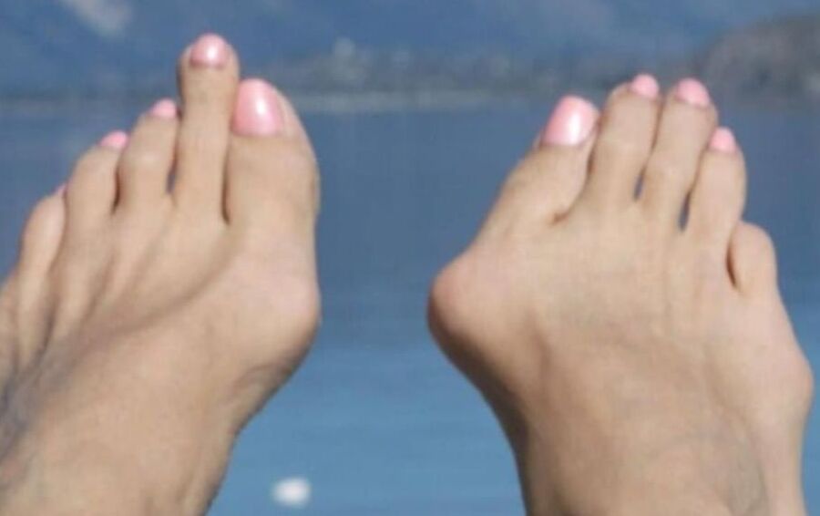 Beautiful bunions