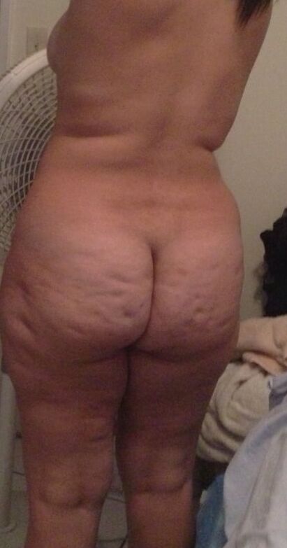 cellulite