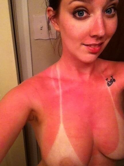 Randon sun burn women sunburn sunburnt pt