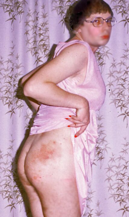 Bruises